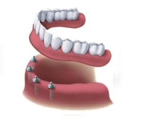 All On 4 Dental Implant Cost Perth