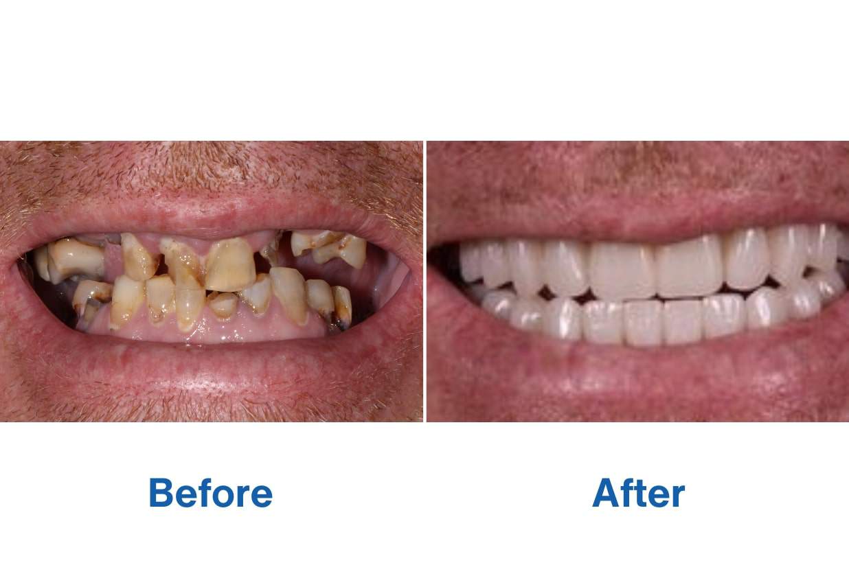 Before and After Complete Smile Makeover with Full Dental Implants
