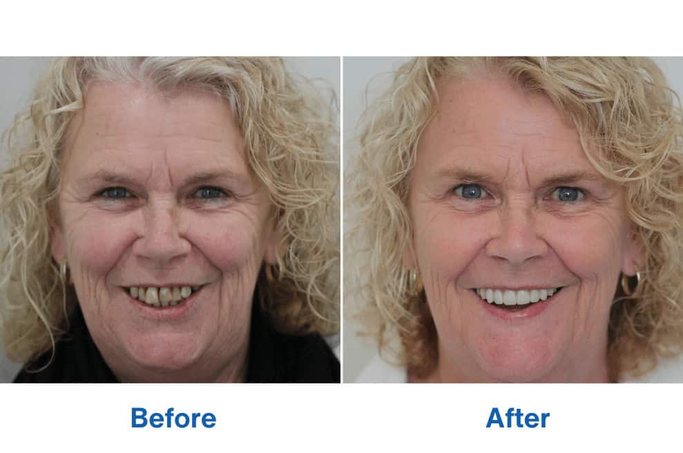 Before and After Dental Implants Perth - Patient Kim Smile Makeover - Tooth Replacement Procedure