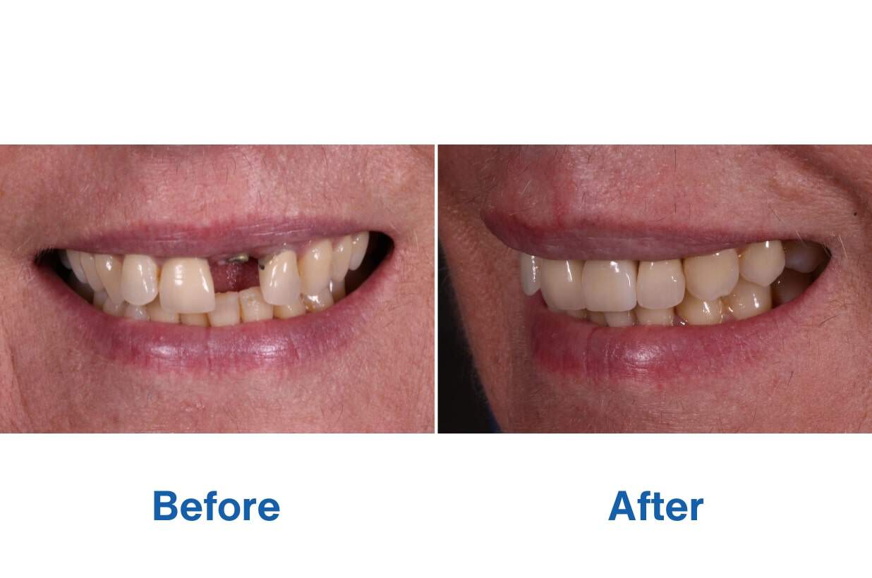 Before and After Patient Smile with Dental Implants - Teeth Replacement Perth