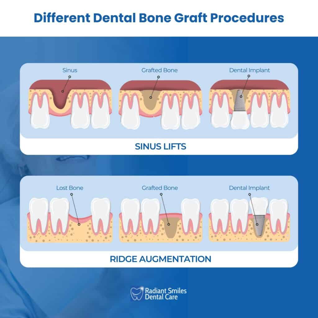 Different Dental Bone Graft Procedures