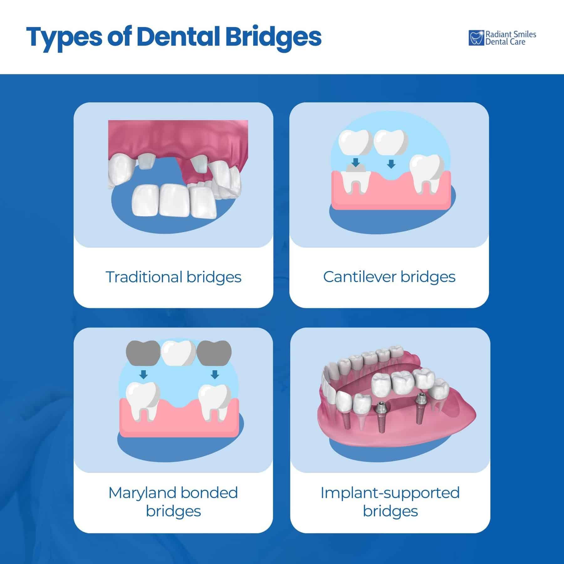 Types of Dental Bridges