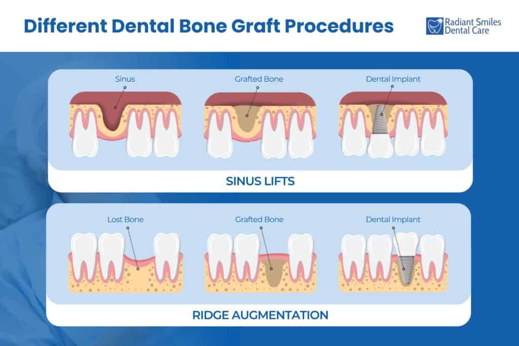 Types of Procedures for Dental Bone Grafts